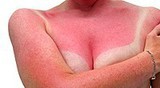How To Get Quick Sunburn Relief